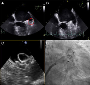 Case example of ATTR cardiac amyloidosis presenting a thrombus during the first attempt at left atrial appendage closure (A); after 1 month of subcutaneous low-weight heparin, the thrombus disappeared (B) and the procedure could be successfully performed (C: echocardiographic guidance of deployment; D: angiographic result).