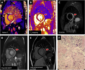 Examples of myocarditis after mRNA vaccination against severe acute respiratory syndrome coronavirus 2 (SARS-CoV-2) confirmed with cardiac magnetic resonance imaging and endomyocardial biopsy. Involvement of the basal lateral face (arrow) meets T1 (A: prolongation of native T1 time; E: late enhancement) and T2 (B: prolongation of T2 time; C: hyperintense signal in T2-weighted images) criteria and is visible in the cine sequence performed after contrast administration (D). Biopsy (F) shows mild lymphoplasmacytic inflammation with eosinophils, interstitial edema, and minimal necrosis of cardiomyocytes. Post-GD SSFP, steady-state free precession after administration of contrast agent (gadolinium); PSIR, phase-sensitive inversion recovery; STIR, short tau inversion recovery.