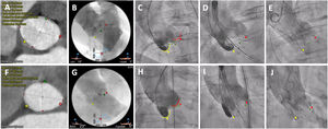 Standard 3-cusp view (LAO) vs cusp overlap (RAO/CAU) technique. A-E: conventional 3-cusp implantation technique. A-C: cardiac computed tomography and baseline aortogram showing the classic coplanar projection with 3 cusps: NCC (yellow) on the left side, RCC (green) in the middle and LCC (red) on the right side. D-E: initial positioning of a Portico valve and final assessment under a 3-cusp view. F-J: cusp overlap implantation technique. F-H: computed tomography and angiogram in a RCC/LCC cusp overlap view: in this projection, the NCC (yellow) is on the left side and the RCC (green) and LCC (red) are overlapped on the right side. I-J: valve positioning and final assessment in a cusp overlap view. Dotted lines represent implantation depth (distance from the NCC to the ventricular end of the TAVI frame). CAU, caudal; LAO, left anterior oblique; LCC, left coronary cusp; NCC, noncoronary cusp; RAO, right anterior oblique; RCC, right coronary cusp.