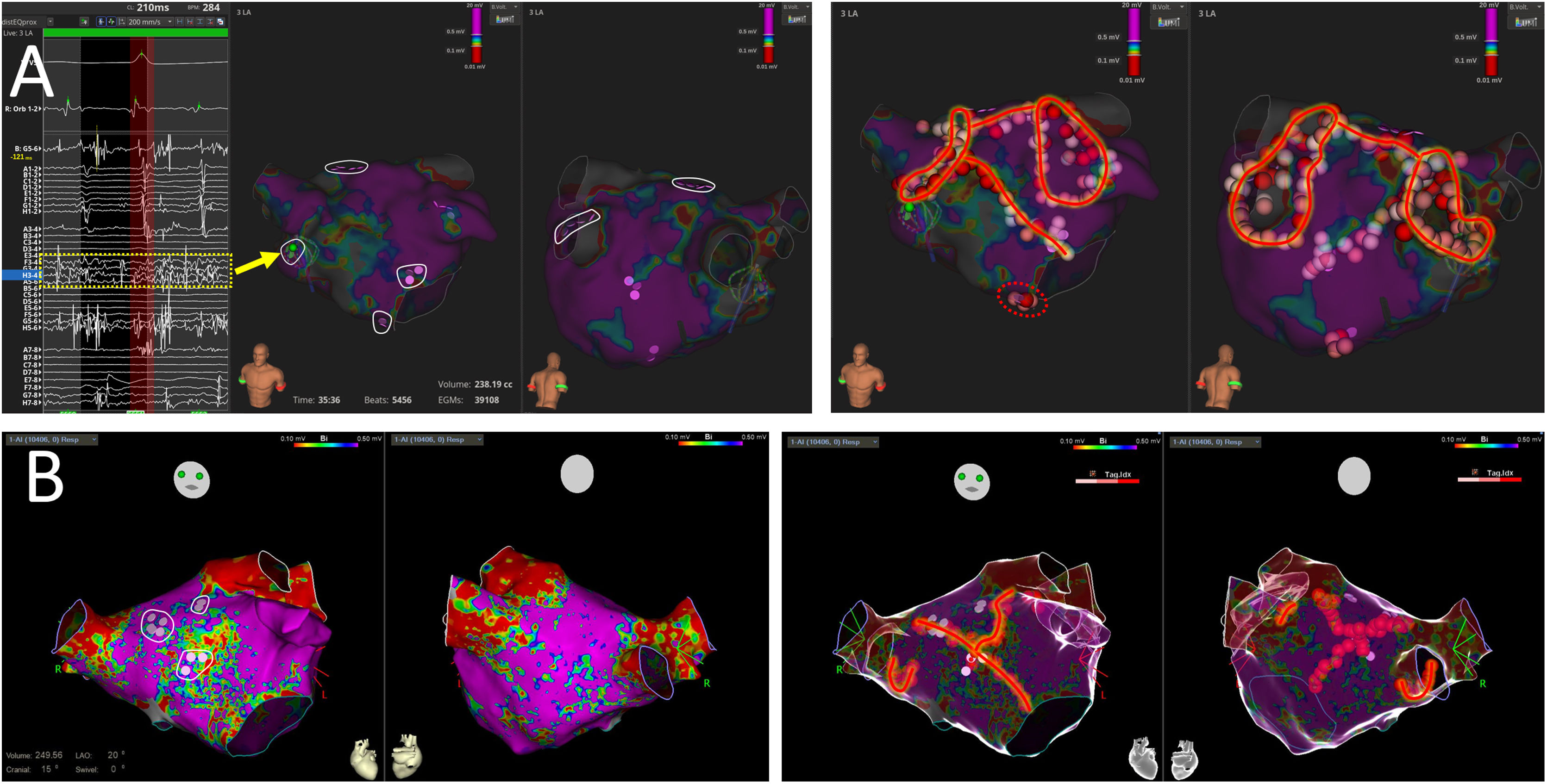 Subjective identification and ablation of drivers improves rhythm ...