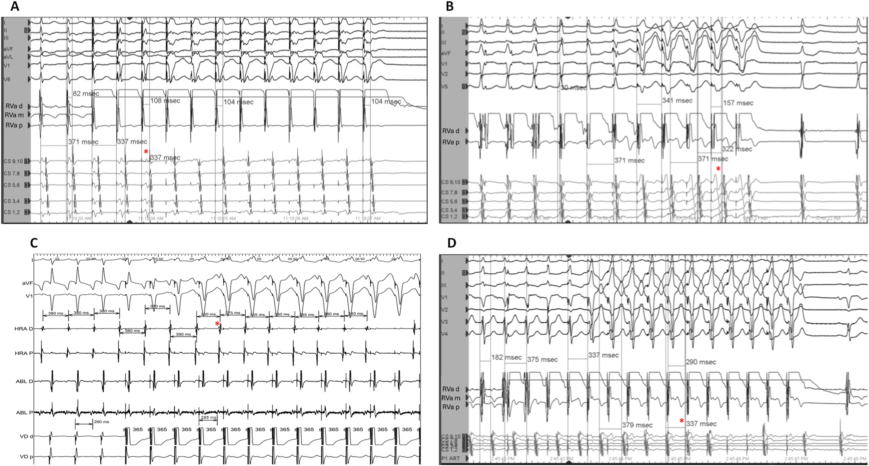 Negative SA-VA difference during ventricular overdrive pacing of