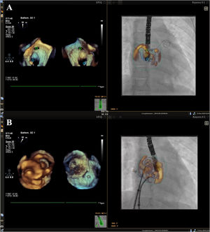 Graphical Abstract Echocardiographic-fluoroscopic fusion imaging with...