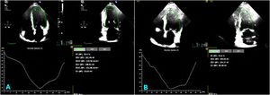 Graphical Abstract Iron heart: cardiomyopathy secondary to liver dise...