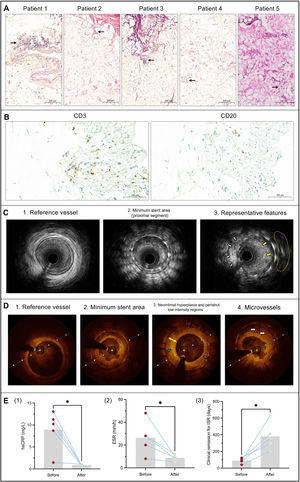 Graphical Abstract Rapid recurrences of coronary unexplained in-stent...