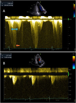 Graphical Abstract Hypertrophic cardiomyopathy with sequential intrac...