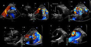 Graphical Abstract Corkscrew aortic arch. PHACES syndrome