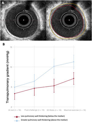 Graphical Abstract Intravascular ultrasound to assess adverse pulmona...