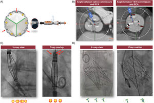 Graphical Abstract Commissural alignment with the Allegra transcathet...