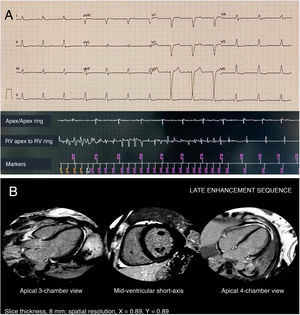 Graphical Abstract FLNC mutation associated with sudden cardiac death...