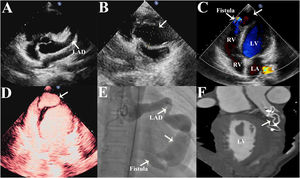 Graphical Abstract Dissecting septal aneurysm as a complication of a ...