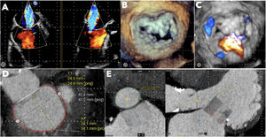 Graphical Abstract Transcatheter mitral valve replacement. The beginn...