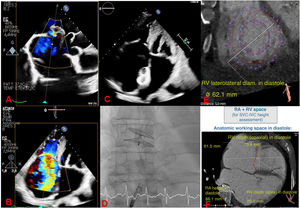 Graphical Abstract Sequential percutaneous approach to carcinoid tric...