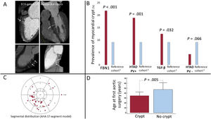 Graphical Abstract Myocardial crypts in FBN1-positive Marfan syndrome