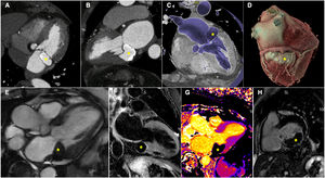 Graphical Abstract Unmasking the rupture: multimodality imaging of a ...