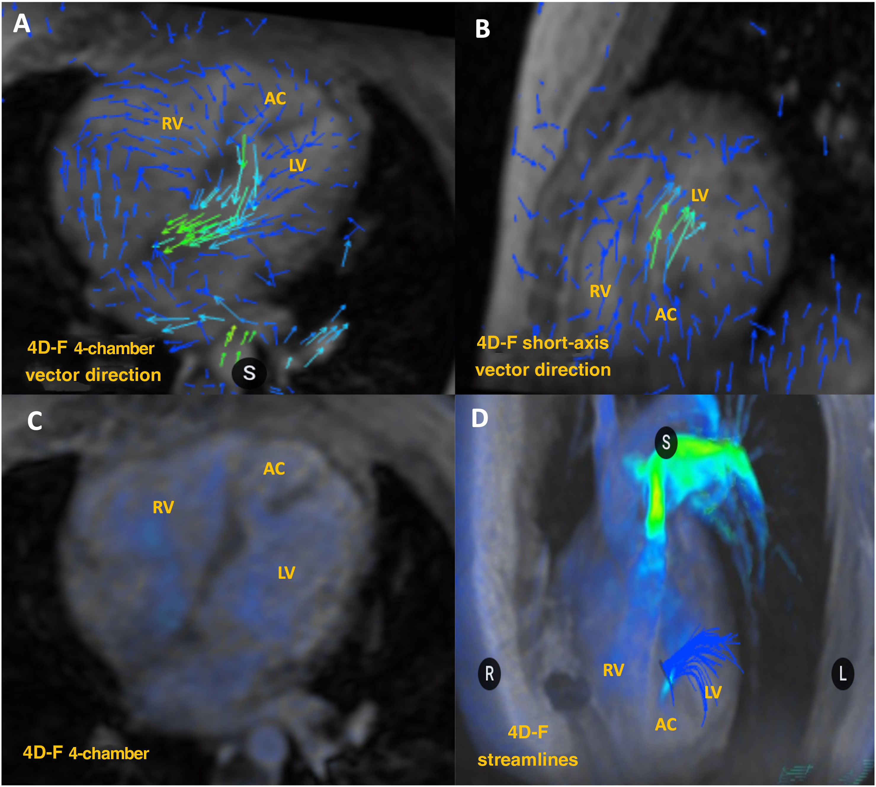 4D-flow CMR Assessment: A Key Tool In Corrected Congenital Heart ...