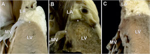 Photographs of autopsy heart specimens showing longitudinal sections through the atrial wall-mitral annulus-ventricular wall junction. A: mitral valve with the classic type of mitral valve hinge line (no mitral annular disjunction). B and C: ventricular mitral annular disjunction type with visible spatial displacement of the mitral leaflet hinge line toward the LV. The mitral leaflet insertion point (asterisk) is located precisely between the LA and LV myocardium. The cross (x) indicates the highest point of the LV myocardium. LA, left atrium; LV, left ventricle; MV, mitral valve.