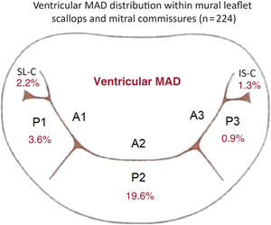 A diagram representing the distribution of v-MAD across the mural mitral valve leaflet scallops (P1, P2, and P3) and mitral commissures based on data from the entire study cohort (n=224). IS-C, inferoseptal commissure; SL-C, superolateral commissure; v-MAD, ventricular mitral annular disjunction.