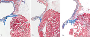 Histological images (Masson's trichrome staining) showing longitudinal sections through the mitral atrioventricular junction with 2 distinct types of junction arrangements. A: mitral valve with no-MAD (classic type). The mitral leaflet insertion point (asterisk) is located between the LA and LV myocardium. B and C: mitral valve with ventricular mitral annular disjunction. Significant spatial displacement of the mitral leaflet hinge line (asterisk) toward the LV with overlapping atrial and ventricular walls can be observed. The cross (x) indicates the highest point of the LV myocardium. LA, left atrium; LV, left ventricle; MV, mitral valve.
