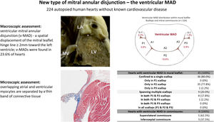 Central illustration. A new type of mitral annular disjunction, termed ventricular MAD. The cross (x) indicates the highest point of the left ventricle myocardium, and the asterisk the mitral leaflet insertion point. IS-C, inferoseptal commissure; LA, left atrium; LV, left ventricle; MV, mitral valve; SL-C, superolateral commissure; v-MAD, ventricular mitral annular disjunction.