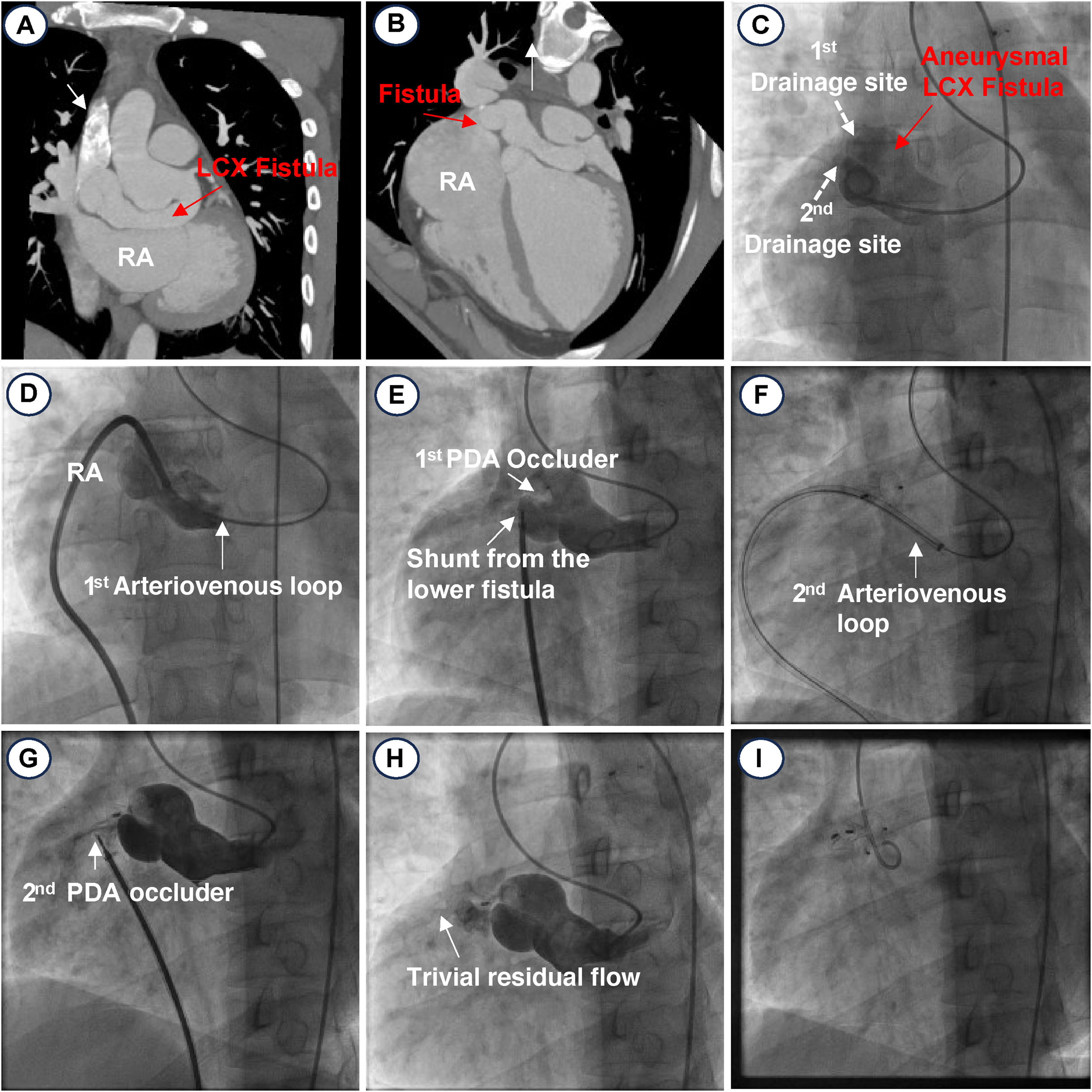 Transcatheter closure of multiple coronary artery fistulas: a coronary ...