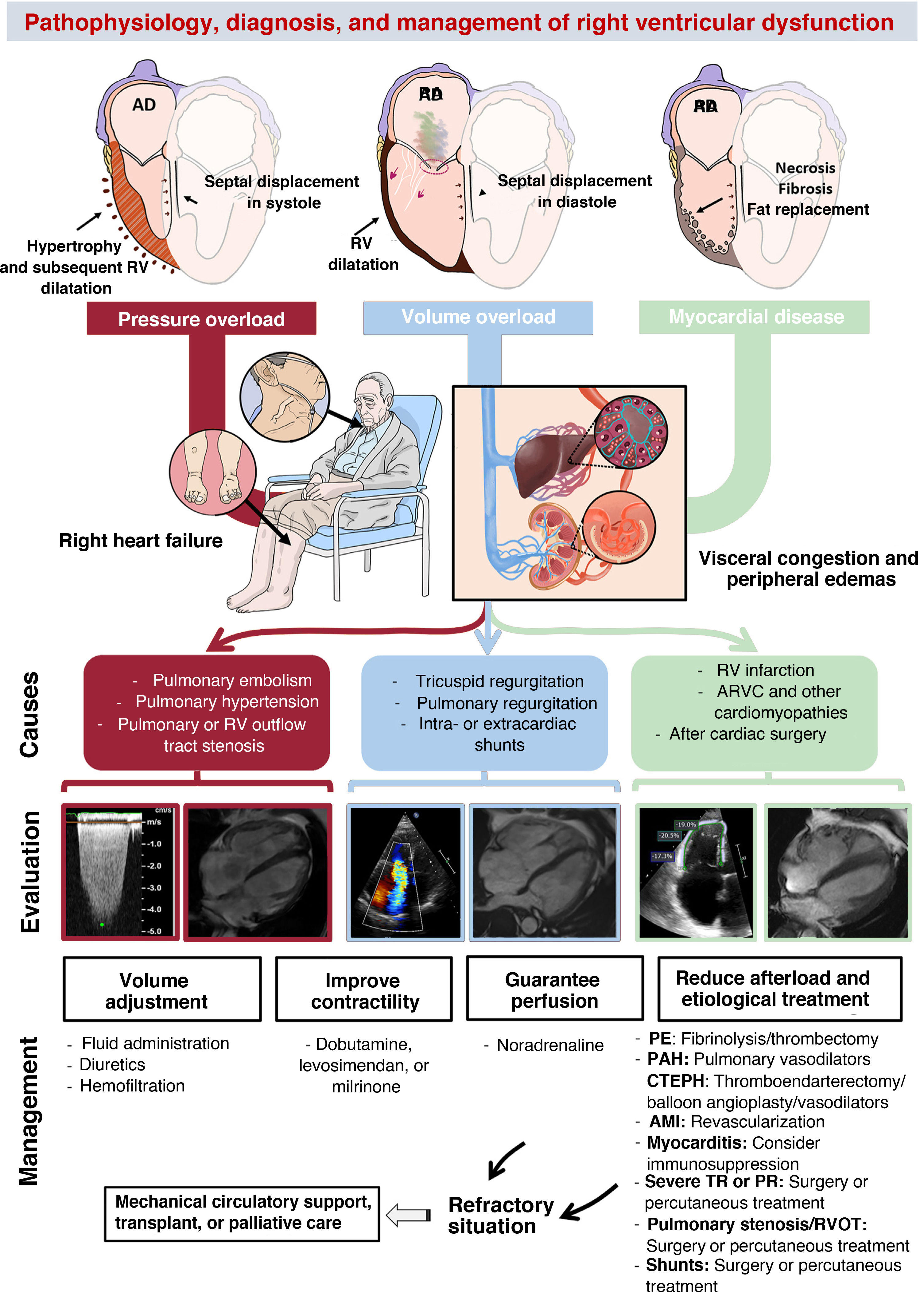 Right ventricular dysfunction: pathophysiology, experimental models ...