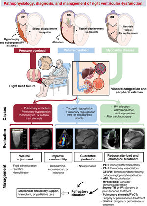 Central illustration. Pathophysiology, diagnosis, and management of right ventricular dysfunction. AMI, acute myocardial infarction; ARVC, arrhythmogenic right ventricular cardiomyopathy; CTEPH, chronic thromboembolic pulmonary hypertension; PAH, pulmonary arterial hypertension; PE, pulmonary embolism; PR, pulmonary regurgitation; RA, right atrium; RV, right ventricular; RVOT, right ventricular outflow tract; TR, tricuspid regurgitation. Cardiac magnetic resonance imaging of volume overload courtesy of Dr Amparo Esteban, Hospital Universitario La Moraleja.