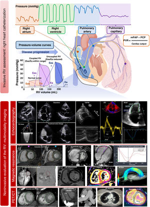 Main methods for assessing the right ventricle. A’, late diastolic velocity of the mitral annulus; CT, computed tomography; E’, early diastolic velocity of the mitral annulus; Ea, effective arterial elastance; Ees, end-systolic elastance; ED, end-diastole; ES, end-systole; ET, ejection time; FDG, fluorodeoxyglucose; IVS, interventricular septum; LV, left ventricle; mPAP, mean pulmonary arterial pressure; PA, pulmonary artery; PCP, pulmonary capillary pressure; PE, pulmonary embolism; PET, positron emission tomography; PIA, pulmonary inferior artery; PIP, posterior inferior papillary muscle; PVR, pulmonary vascular resistance; RVEF, right ventricular ejection fraction; RV, right ventricle; S’, peak systolic velocity of the mitral annulus; TAPSE, tricuspid annular plane systolic excursion; TCO, tricuspid closure-opening time; TDI, tissue Doppler imaging; TR, tricuspid regurgitation; Vmax, maximal expiratory flow; WL, wall length; WW, wall-to-wall.