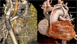 Graphical Abstract Univentricular heart with anomalous venous drainag...