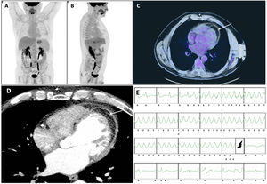Graphical Abstract Extensive circumferential fatty infiltration of th...