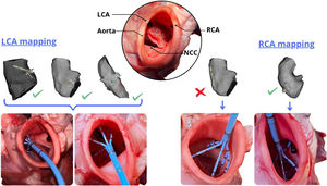 Graphical Abstract Multispline catheter mapping of the coronary ostia...