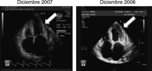 Progresión en la hipertrofia ventricular izquierda.