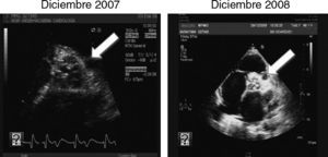 Progresión en la calcificación de la válvula aórtica.