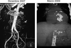 Imágenes comparadas de la progresión de las calcificaciones a nivel de grandes vasos abdominales.