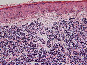 Carcinoma de células de Merkel: CK 20 paranuclear. TTF-1negativo.
