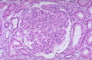 Light microscopy revealing enlarged and lobulated glomerulus with increase in mesangial matrix and cellularity and thickening of capillary basement membrane.