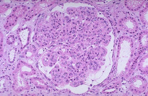Light microscopy revealing enlarged and lobulated glomerulus with increase in mesangial matrix and cellularity and thickening of capillary basement membrane.