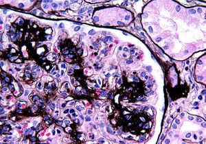 PAM Silver stain revealing thickening and double contour of capillary basement membranes.