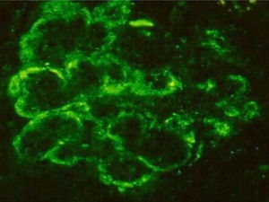Immunofluorescent microscopy revealing the presence of the complement protein C3 which produces a characteristic ribbon-like staining pattern of the peripheral capillary loops.