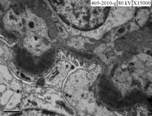 Electron microscopy showing thickening of basement membrane with homogenous electron dense deposits.