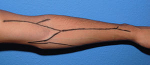 Cephalic, basilic and median veins in the left arm and forearm.