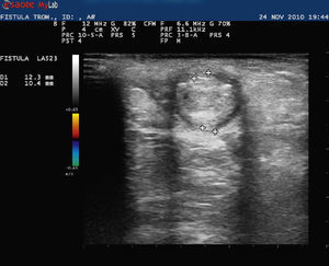 Left brachial thrombosed fistula distal venous area.
