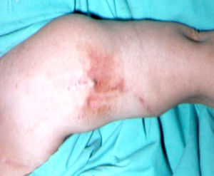 Infection of VA prosthesis.