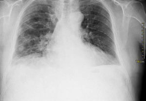 Chest X-ray: multiple bilateral ground-glass opacities.