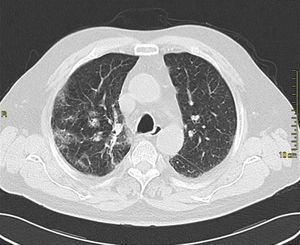 Lung CT-scan: multiple bilateral consolidations and bilateral pleural effusion.