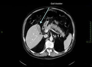 Abdomen CT-scan: greatly thickened gallbladder and bile duct walls with contrast enhancement.