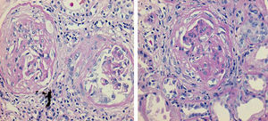 Histología renal. Glomérulos con profileración extracapilar fibrocelular, necrosis fibrinoide segmentaria y esclerosis segmentaria cicatrizal (40X).