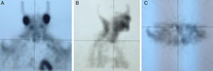 SPECT de la paciente en la que se observa una localización tridimensional más anatómica de la paratiroides inferior derecha. A) Corte coronal (anterior a posterior). B) Corte sagital (derecha a izquierda). C) Corte transversal (de cabeza a pies).