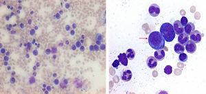 Frotis médula ósea. Se muestran gigantoblastos eritroides (proeritroblastos) con inclusiones eosinófilas intranucleares y carencia de normoblastos tardíos, constituyen el diagnóstico morfológico de APSR (40x).