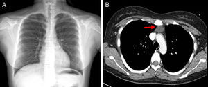 A) Radiografía de tórax a su ingreso. B) Tomografía torácica en la que se muestra timoma en mediastino anterior.