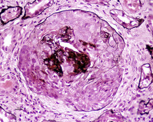 Light microscopy – PAS stain showing circumferential cellular crescent.